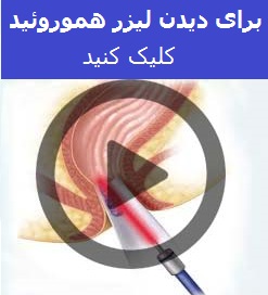 لیزر هموروئید داخلی را در این ویدئو ببینید