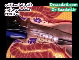 عمل جراحی هموروئید