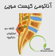کیست مویی پایین کمر