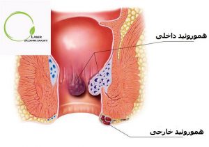 هموروئید-بواسیر
