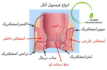 انواع فیستول مقعد یا فیستول آنال در تصویر مشاهده می کنید.سوال های رایج برای درمان فیستول.فواید لیزر در درمان فیستول مقعد,اگر فیستول مقعد درمان نشود,اگر آبسه مقعد درمان نشود