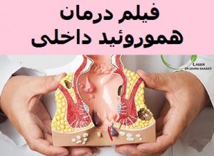 ویدئو درمان هموروئید داخلی