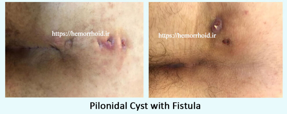 What Is A Pilonidal Cyst Dr Zahra Saadati Laser Surgery