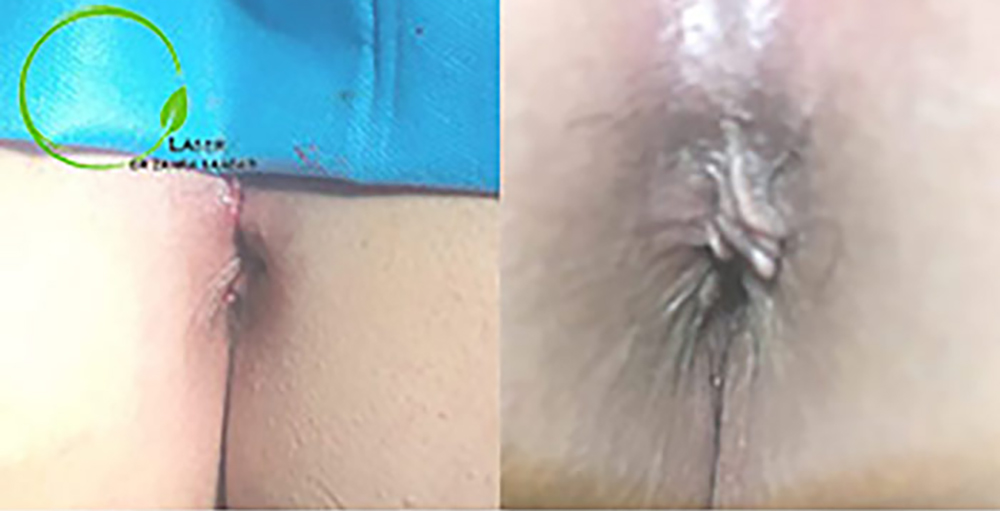 These images show a case of hemorrhoids before and after surgery with high-power laser