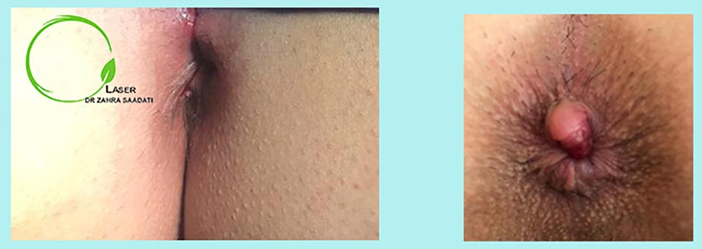 Before and after image of hemorrhoid laser
