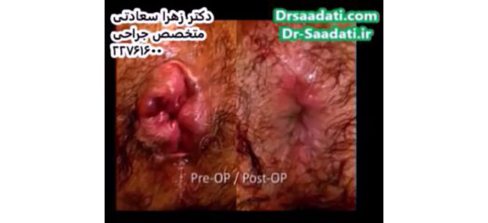 قبل و بعد جراحی هموروئید