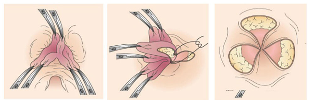 Open hemorrhoid surgery