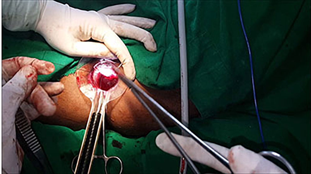 hemorrhoid surgery