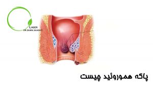 پاکه هموروئید چیست