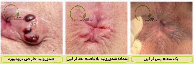 درمان هموروئید ترومبوزه