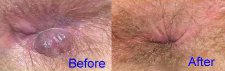 لیزر درمانی هموروئید خارجی-قبل و بعد