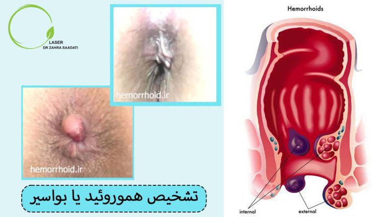 تشخیص هموروئید یا بواسیر