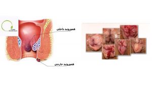 انواع هموروئید