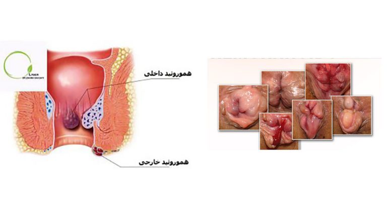 انواع هموروئید