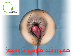 هموروئید ترومبوزه-هموروئید خارجی ترومبوز