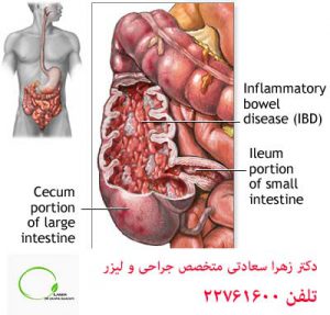 روده تحریک پذیر