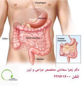 خونریزی مقعدی بر اثر بیماری های کلون و راست روده