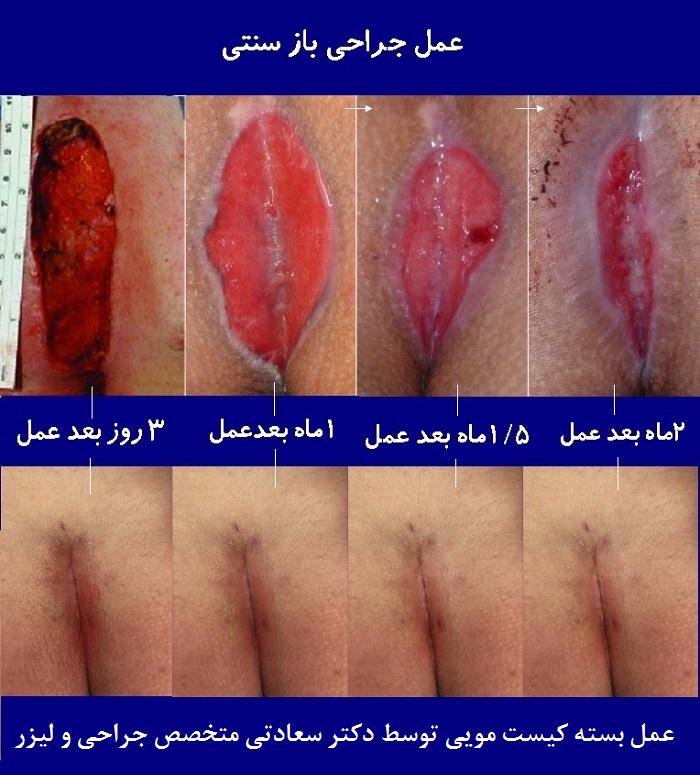 عمل جراحی کیست مویی به روش بسته با لیزر
