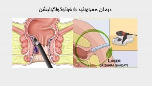 درمان هموروئید با فوتوکواگولیشن