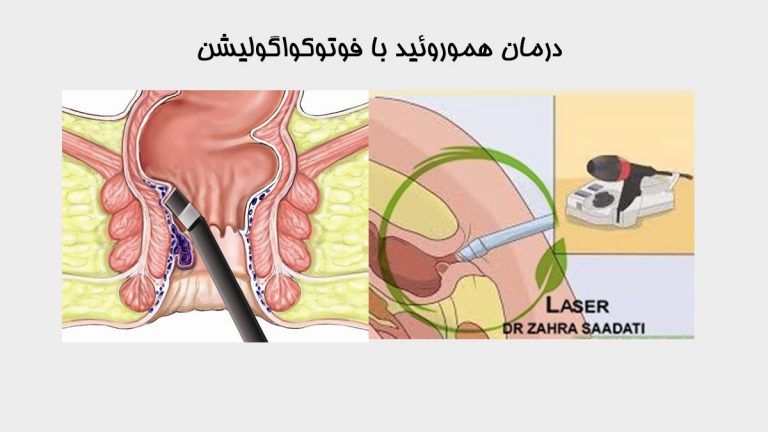 درمان هموروئید با فوتوکواگولیشن