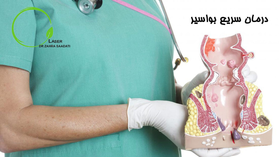 درمان سریع بواسیر و بهترین و موثرترین روش های ممکن جراحی با لیزر و دارو