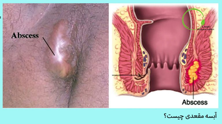 آبسه مقعدی چیست تصویر و آناتومی