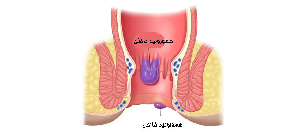 هموروئید داخلی و هموروئید خارجی