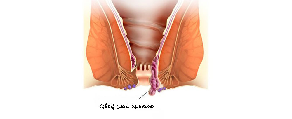 هموروئید داخلی پرولابه