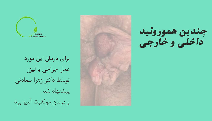 چندین هموروئید داخلی