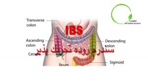 سندرم روده تحریک پذیر