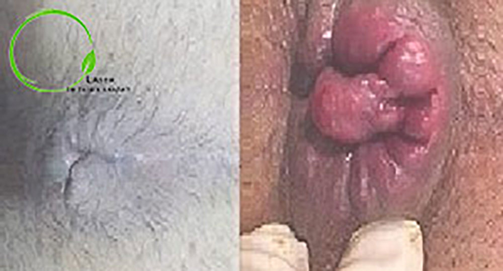 before and after of hemorrhoid laser
