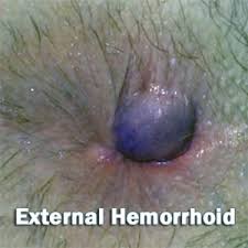 Thrombosed external hemorrhoids