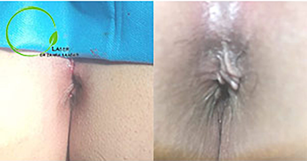 قبل و بعد جراحی لیزر هموروئید عکس بواسیر زنان