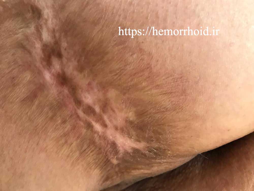 Hemorrhoids burned with a hot brick