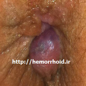 Thrombosis external hemorrhoids photo of hemorrhoids in women