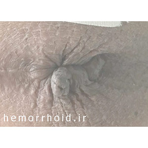 hemorrhoid or tumor