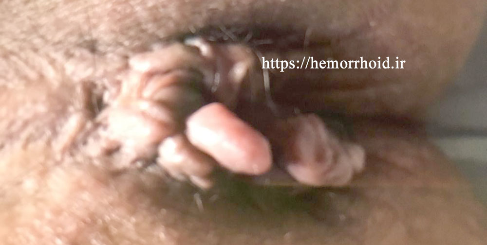 Prolapsed internal hemorrhoids