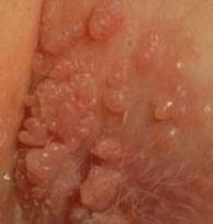 زگیل تناسلی بر اثر ویروس HPV بروز می کند و شکل ظاهری کلم شکل و تبخال مانند دارد