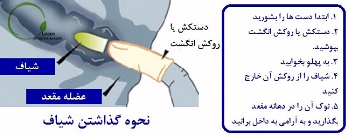 روش گذاشتن شیاف در مقعد