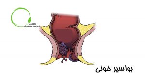 بواسیر خونی