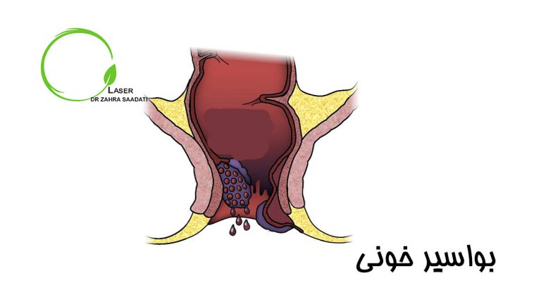 بواسیر خونی