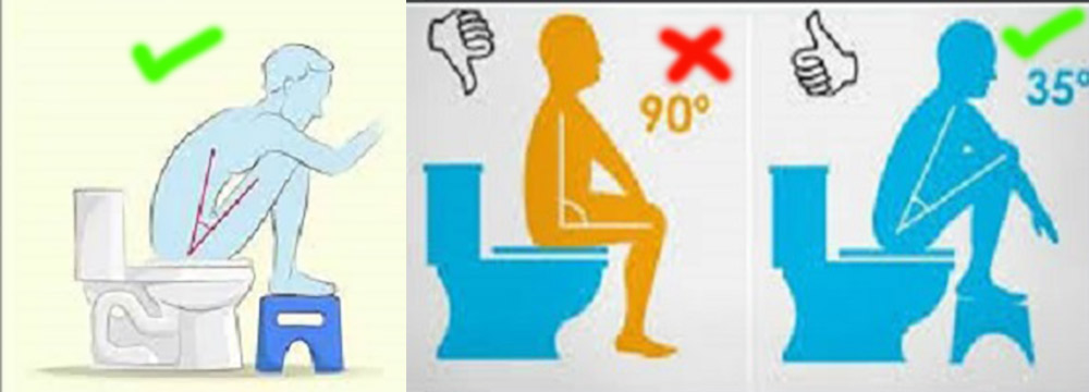 Use a toilet step to prevent colonic diseases and hemorrhoids