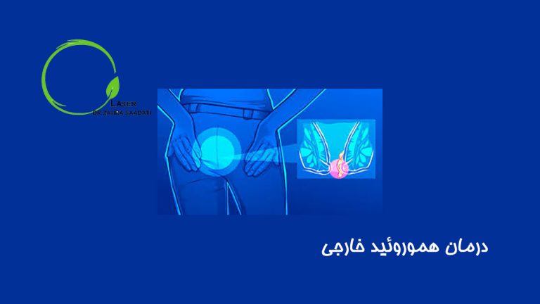 درمان هموروئید خارجی