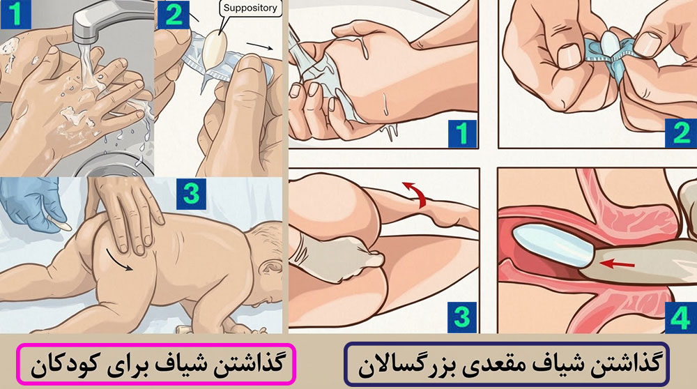 روش استفاده از شیاف آنتی هموروئید برای کودکان و بزرگسالان