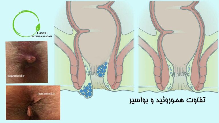 تفاوت هموروئید و بواسیر