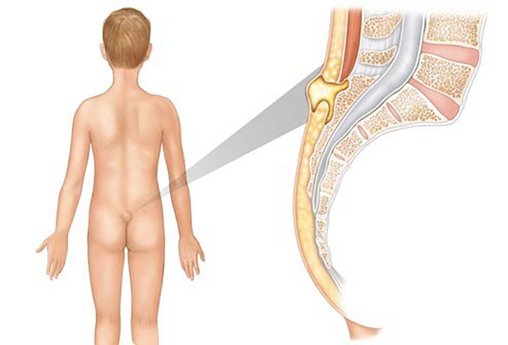 انیمیشن پسری که به پشت ایستاده و ناحیه ساکروم و محل تشکیل کیست مویی پایین کمر نشان داده شده است