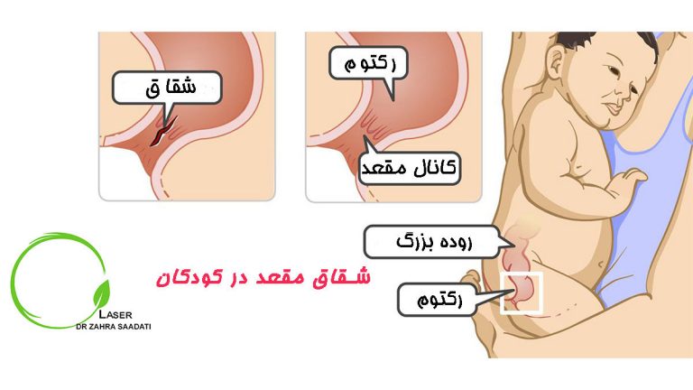 شقاق مقعد کودکان