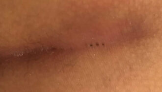 Pilonidal Abscess Child What is a Pilonidal Cyst? - Dr. Zahra Saadati Laser Surgery