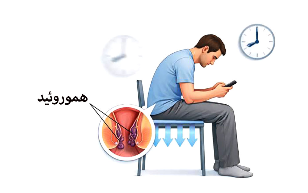 نشستن طولانی یک آقا بر روی صندلی و فشار به ناحیه مقعد منجر به بروز هموروئید یا بواسیر شده است.