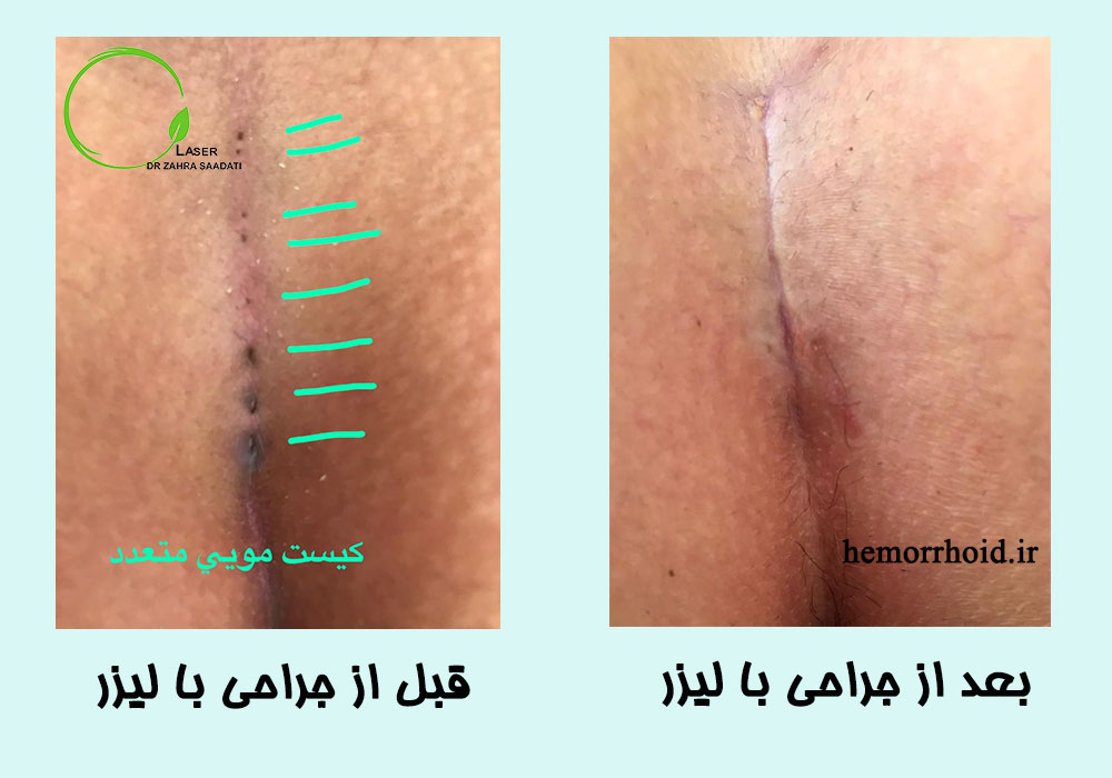 قبل و بعد جراحی کیست مویی یا مو برگشتی